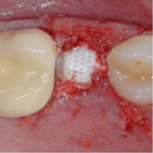 Oral Bond Sterile Adhesive - Avtec Surgical